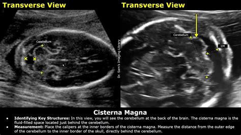 cisterna magna ultrasound fetal measurement.